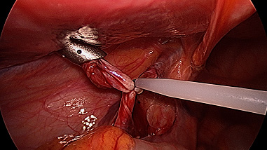Technika podwiązania żylaków metodą laparoskopową